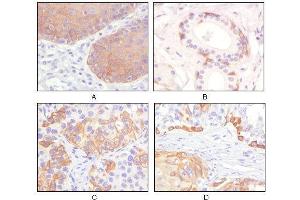 Immunohistochemical analysis of paraffin-embedded human esophagus epithelium (A), salivary gland basal cell (B), lung squamous cell carcinoma (C), endometrium admosquamous carcinoma (D), showing cytoplasmic and membrane localization using CK5 mouse mAb with DAB staining. (Cytokeratin 5 Antikörper)