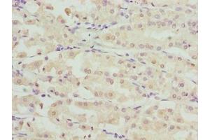 Immunohistochemistry of paraffin-embedded human gastric cancer using ABIN7168087 at dilution of 1:100 (RIBC2 Antikörper  (AA 1-309))