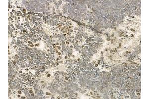 ABIN6258315 and ABIN6274373 at 1/100 staining human melanoma by IHC-P. (RHOH Antikörper  (Internal Region))