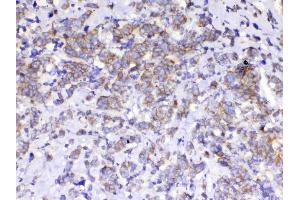 IHC analysis of beta Catenin using anti-beta Catenin antibody . (CTNNB1 Antikörper  (AA 2-233))
