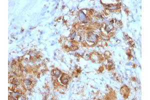 Formalin-fixed, paraffin-embedded human Gastric Carcinoma stained with CA19-9 Mouse Monoclonal Antibody (121SLE). (CA 19-9 Antikörper)