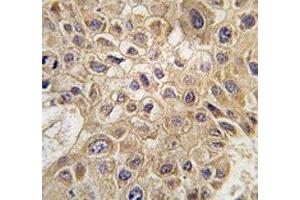 IHC analysis of FFPE human hepatocarcinoma tissue stained with AMFR antibody (AMFR Antikörper  (AA 571-601))