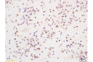 Formalin-fixed and paraffin embedded human glioma tissue labeled with Anti PIRH2 Polyclonal Antibody, Unconjugated (ABIN1386185) at 1:200 followed by conjugation to the secondary antibody and DAB staining (RCHY1 Antikörper  (AA 31-130))