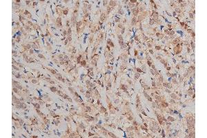 ABIN6269240 at 1/200 staining human breast cancer tissue sections by IHC-P. (STAT3 Antikörper  (C-Term))