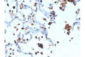 Formalin-fixed, paraffin-embedded human Lung Adenocarcinoma stained with Napsin A Mouse Monoclonal Antibody (NAPSA/3308). (NAPSA Antikörper  (AA 189-299))
