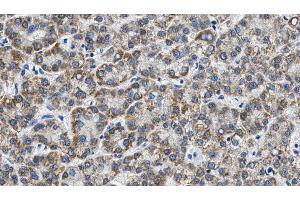 ABIN6268691 at 1/100 staining Human liver cancer tissue by IHC-P.