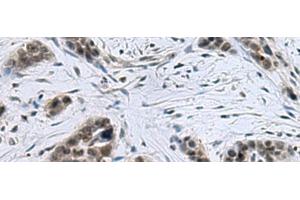 Immunohistochemistry of paraffin-embedded Human thyroid cancer tissue using CCAR2 Polyclonal Antibody at dilution of 1:40(x200) (CCAR2 Antikörper)