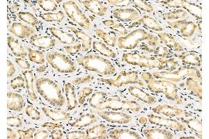 ABIN6261466 and ABIN6266885 at 1/100 staining Human kidney cancer and adjacent normal tissues by IHC-P.