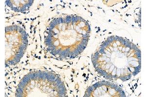 ABIN6261174 and ABIN6273223 at 1/100 staining Human colorectal cancer by IHC-P.