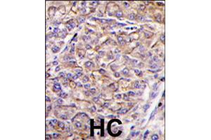 Formalin-fixed and paraffin-embedded human hepatocellular carcinoma reacted with TAOK3 polyclonal antibody  , which was peroxidase-conjugated to the secondary antibody, followed by DAB staining . (TAO Kinase 3 Antikörper  (C-Term))