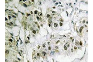 Immunohistochemistry analyzes of CtBP2 antibody in paraffin-embedded human breast carcinoma tissue. (CTBP2 Antikörper)