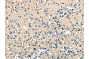 The image on the left is immunohistochemistry of paraffin-embedded Human liver cancer tissue using ABIN7131395(TMPRSS11A Antibody) at dilution 1/30, on the right is treated with fusion protein. (TMPRSS11A Antikörper)