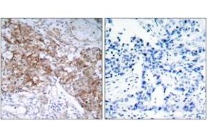 Immunohistochemistry analysis of paraffin-embedded human breast carcinoma tissue, using IGF1R (Ab-1161) Antibody. (IGF1R Antikörper  (AA 1126-1175))