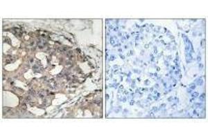Immunohistochemistry analysis of paraffin-embedded human breast carcinoma tissue using B-RAF (Ab-446) antibody. (BRAF Antikörper  (Ser446))