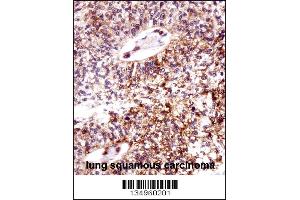 ECT2 Antibody immunohistochemistry analysis in formalin fixed and paraffin embedded human lung squamous carcinoma followed by peroxidase conjugation of the secondary antibody and DAB staining. (ECT2 Antikörper  (AA 597-625))