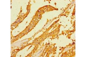 Immunohistochemistry of paraffin-embedded human endometrial cancer using ABIN7165442 at dilution of 1:100 (FAM167A Antikörper  (AA 1-214))