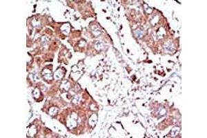 IHC analysis of FFPE human hepatocarcinoma tissue stained with the ALK3 antibody (BMPR1A Antikörper  (AA 166-195))