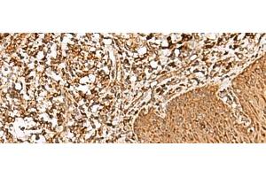 Immunohistochemistry of paraffin-embedded Human esophagus cancer tissue using FAM200A Polyclonal Antibody at dilution of 1:55(x200) (FAM200A Antikörper)