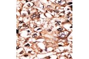 Formalin-fixed and paraffin-embedded human cancer tissue reacted with the primary antibody, which was peroxidase-conjugated to the secondary antibody, followed by DAB staining. (TNFRSF1A Antikörper  (pSer274))