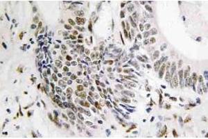 Immunohistochemistry (IHC) analyzes of Rad51 antibody in paraffin-embedded human colon carcinoma tissue. (RAD51 Antikörper)