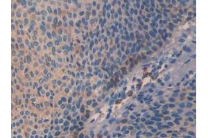 DAB staining on IHC-P; Samples: Human Skin cancer Tissue (SLIT3 Antikörper  (AA 1405-1512))