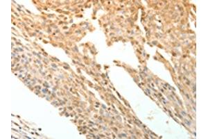 The image on the left is immunohistochemistry of paraffin-embedded Human cervical cancer tissue using ABIN7130780(PTPRE Antibody) at dilution 1/10, on the right is treated with fusion protein. (PTPRE Antikörper)