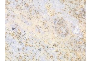 ABIN6263454 and ABIN6269077 at 1/100 staining human gastric carcinoma by IHC-P. (c-MYC Antikörper  (N-Term))