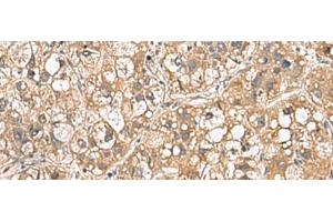 Immunohistochemistry of paraffin-embedded Human liver cancer tissue using PTPRS Polyclonal Antibody at dilution of 1:110(x200)