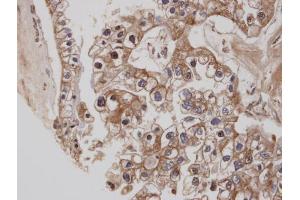 IHC-P Image Immunohistochemical analysis of paraffin-embedded human ovarian cancer, using CB1 , antibody at 1:100 dilution. (CNR1 Antikörper  (C-Term))