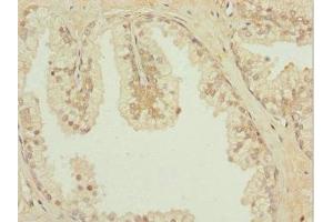 Immunohistochemistry of paraffin-embedded human prostate cancer using ABIN7156889 at dilution of 1:100 (IL31RA Antikörper  (AA 1-300))
