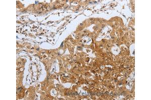 Immunohistochemistry of Human lung cancer using CASP12 Polyclonal Antibody at dilution of 1:50 (Caspase 12 Antikörper)