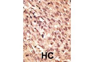 Formalin-fixed and paraffin-embedded human hepatocellular carcinoma tissue reacted with LRP5 polyclonal antibody , which was peroxidase-conjugated to the secondary antibody, followed by AEC staining. (LRP5 Antikörper  (C-Term))