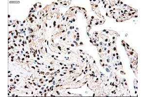 Immunohistochemical staining of paraffin-embedded Adenocarcinoma of breast tissue using anti-TYRO3 mouse monoclonal antibody. (TYRO3 Antikörper)