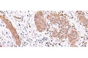 Immunohistochemistry of paraffin-embedded Human esophagus cancer tissue using RUSC1 Polyclonal Antibody at dilution of 1:90(x200) (RUSC1 Antikörper)