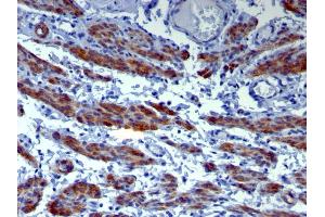 Formalin-fixed, paraffin-embedded human Leiomyosarcoma stained with Caldesmon Mouse Monoclonal Antibody (h-CALD). (Caldesmon Antikörper)