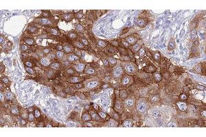 ABIN6276799 at 1/100 staining Human Head and neck cancer tissue by IHC-P. (SELPLG Antikörper  (N-Term))
