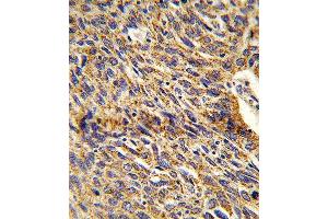 Formalin-fixed and paraffin-embedded human lung carcinoma reacted with DCI Antibody (C-term), which was peroxidase-conjugated to the secondary antibody, followed by DAB staining. (DCI Antikörper  (C-Term))