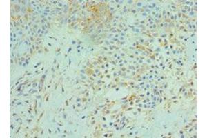 Immunohistochemistry of paraffin-embedded human breast cancer using ABIN7170676 at dilution of 1:100