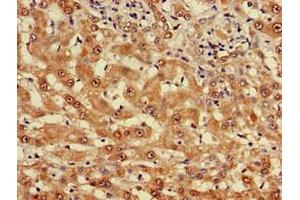 Immunohistochemistry of paraffin-embedded human liver cancer using ABIN7174961 at dilution of 1:100 (Myosin VIIA Antikörper  (AA 838-968))