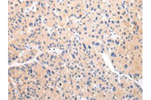 The image on the left is immunohistochemistry of paraffin-embedded Human liver cancer tissue using ABIN7193105(ZNF106 Antibody) at dilution 1/20, on the right is treated with synthetic peptide. (ZNF16 Antikörper)