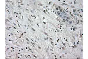 Immunohistochemical staining of paraffin-embedded Carcinoma of kidney tissue using anti-NEK6mouse monoclonal antibody. (NEK6 Antikörper)
