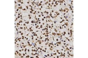 Immunohistochemistry of paraffin-embedded human kidney cancer tissue using H4K20me3 antibody at dilution of 1:200 (x400 lens). (Histone H4 Antikörper  (3meLys20))