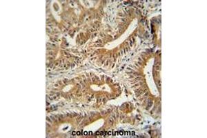 CCDC123 antibody (C-term) immunohistochemistry analysis in formalin fixed and paraffin embedded human colon carcinoma followed by peroxidase conjugation of the secondary antibody and DAB staining. (CEP89 Antikörper  (C-Term))