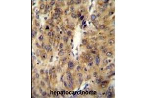 ACF Antibody (C-term) (ABIN654627 and ABIN2844324) immunohistochemistry analysis in formalin fixed and paraffin embedded human hepatocarcinoma followed by peroxidase conjugation of the secondary antibody and DAB staining. (A1CF Antikörper  (C-Term))