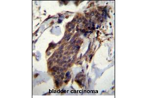 CCDC13 Antibody (N-term) (ABIN656615 and ABIN2845868) immunohistochemistry analysis in formalin fixed and paraffin embedded human bladder carcinoma followed by peroxidase conjugation of the secondary antibody and DAB staining. (CCDC13 Antikörper  (N-Term))