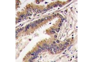 IHC analysis of FFPE human lung carcinoma tissue stained with ERK4 antibody (MAPK7 Antikörper  (AA 527-557))