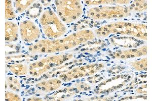 ABIN6263049 and ABIN6273132 at 1/100 staining Human kidney cancer and adjacent normal tissues by IHC-P.