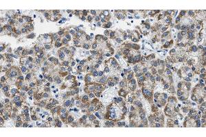 ABIN6268888 at 1/100 staining Human liver cancer tissue by IHC-P. (CD4 Antikörper  (C-Term))