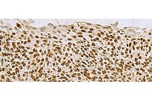 Immunohistochemistry of paraffin-embedded Human lung cancer tissue using TP63 Polyclonal Antibody at dilution of 1:65(x200) (p63 Antikörper)
