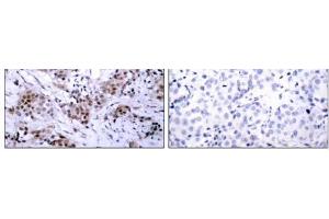 Immunohistochemical analysis of paraffin-embedded human breast carcinoma tissue using Estrogen Receptor-α (Ab-167) antibody (E021068). (Estrogen Receptor alpha Antikörper)